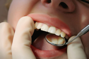 Déchaussement des dents
